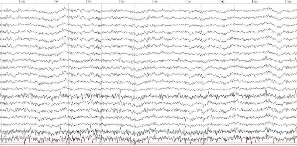 Roh-Daten EEG bei Hypnose-Einleitung mit Pendel